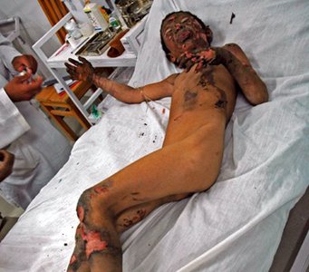 Photos from NATO bomb victims by Maso Notarianni at the Emergency Hospital in Lashkar Gah
